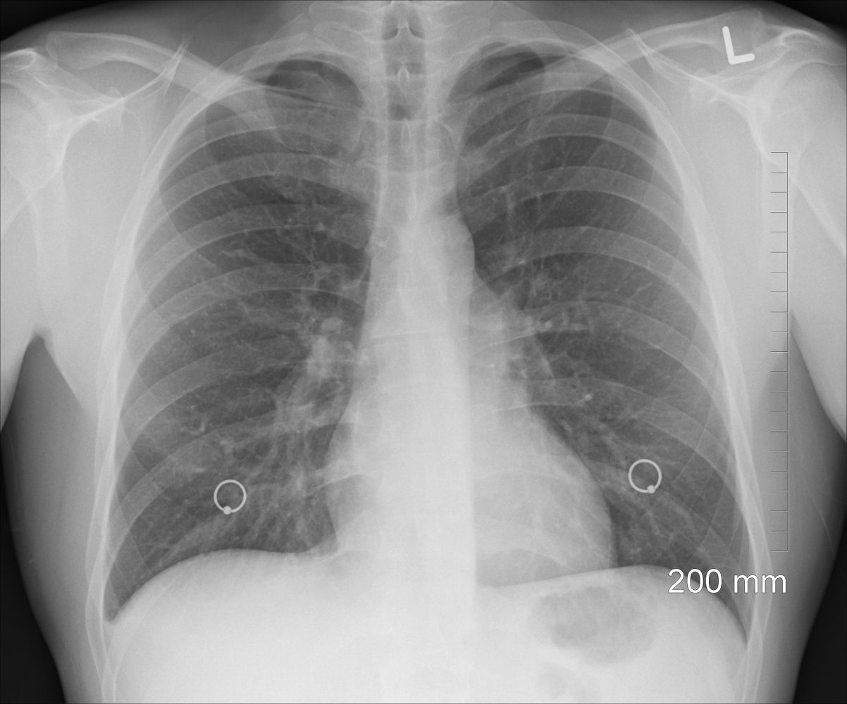 I have interstitial lung disease — What?