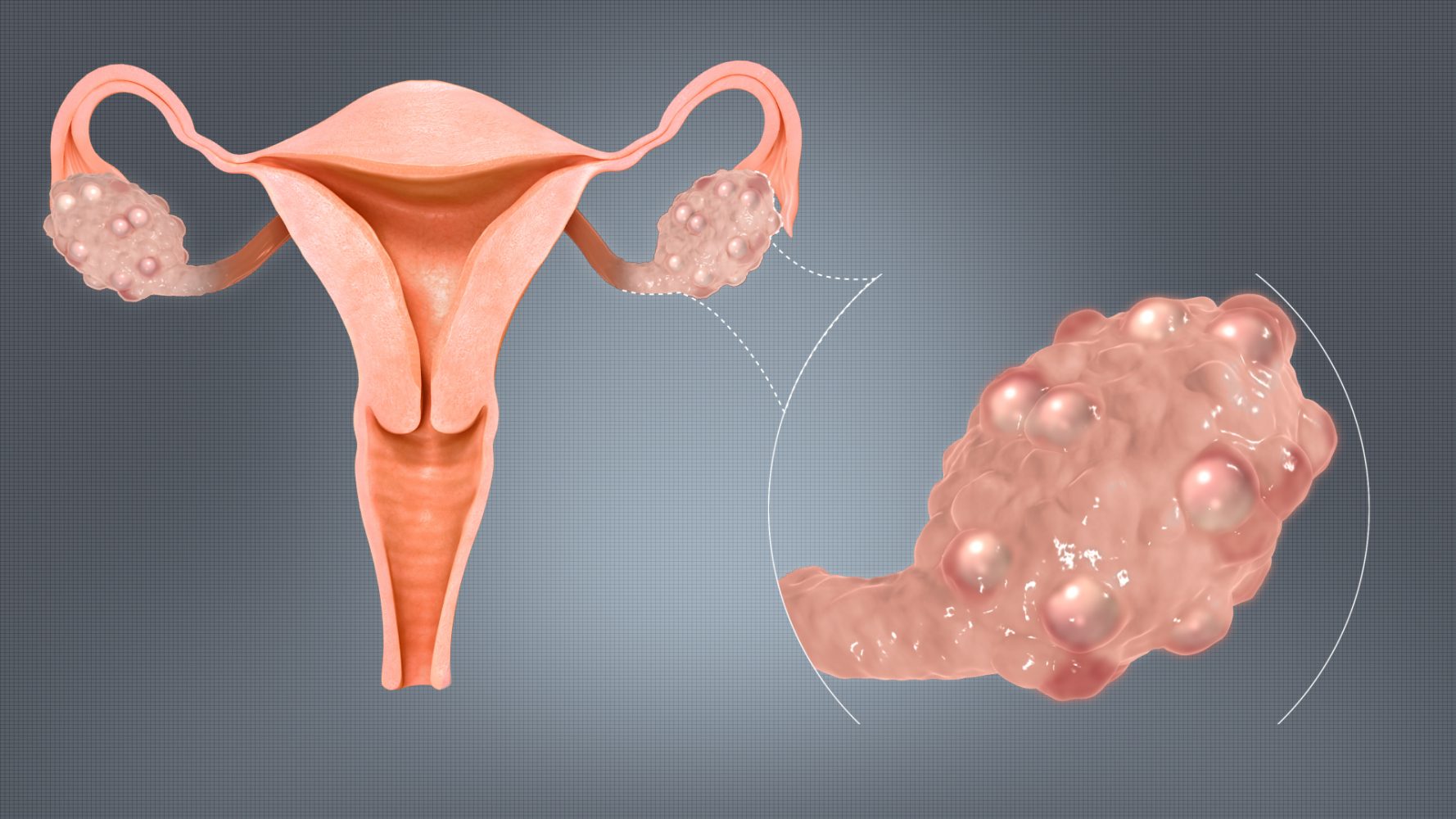 What is Polycystic Ovary Syndrome?